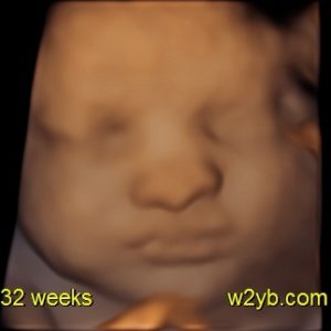 3D Sonography for Pregnancy